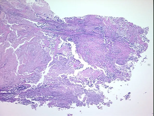 Tissue FFPE Sections, Lung: left upper lobe - image 1