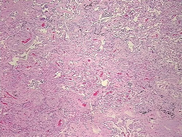 Tissue FFPE Sections, Lung: left upper lobe - image 1