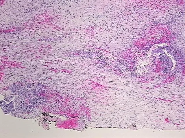 Tissue FFPE Sections, Endometriotic tissue - image 1