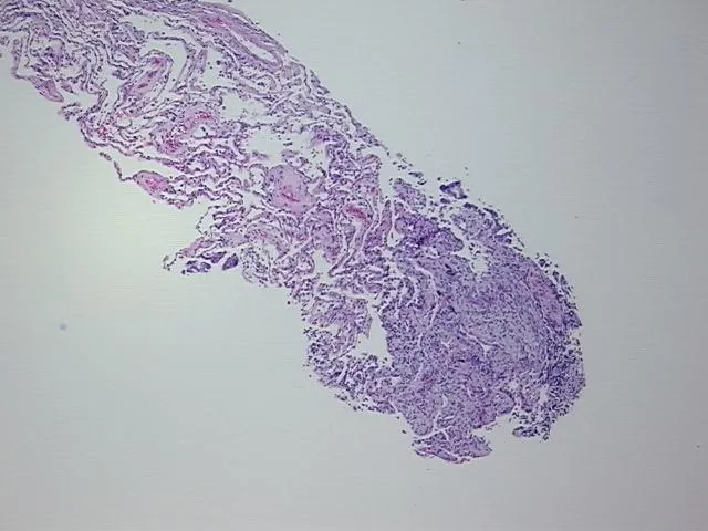 Tissue FFPE Sections, Lung: left lower lobe - image 1