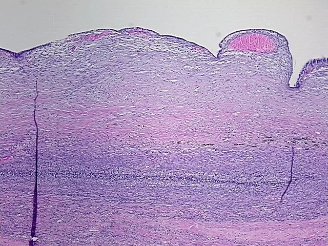Tissue FFPE Sections, Endometriotic tissue - image 1