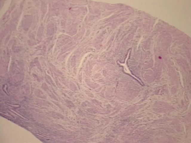 Tissue FFPE Sections, Endometriotic tissue - image 1