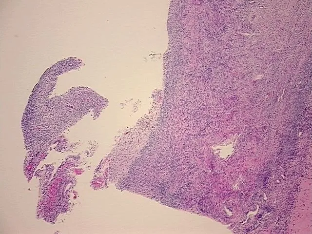 Tissue FFPE Sections, Endometriotic tissue - image 1