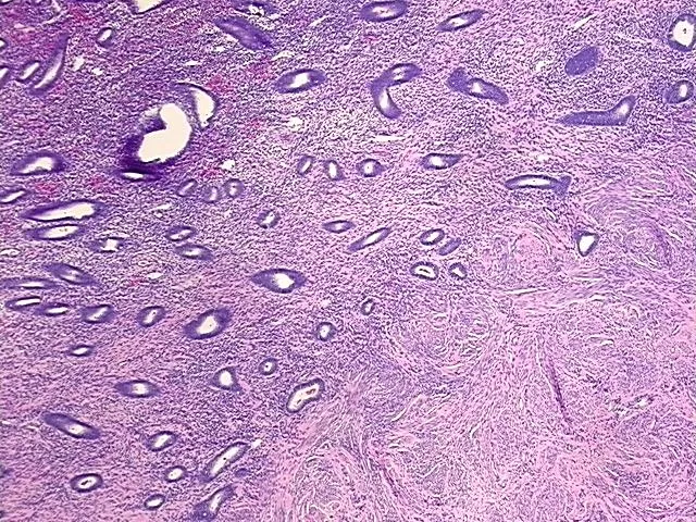 Tissue FFPE Sections, Endometriotic tissue - image 1