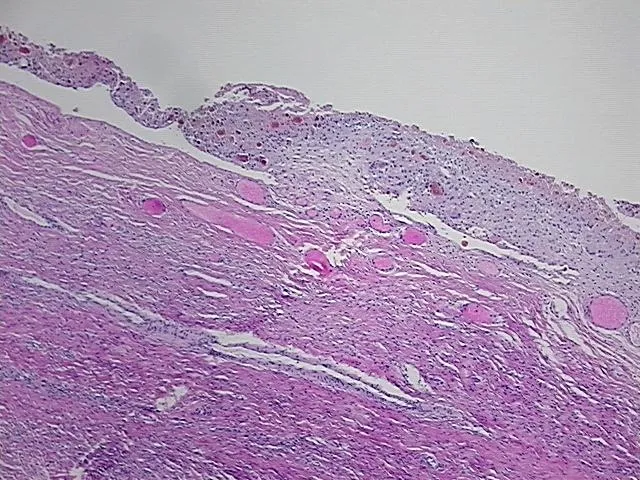 Tissue FFPE Sections, Endometriotic tissue - image 1