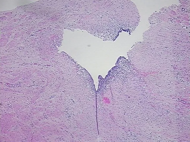 Tissue FFPE Sections, Endometriotic tissue - image 1