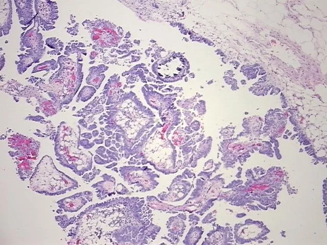 Tissue FFPE Sections, Peritoneum - image 1