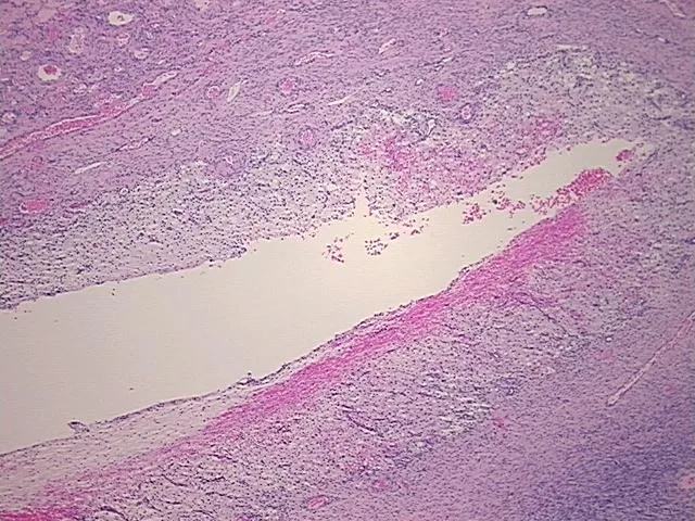 Tissue FFPE Sections, Endometriotic tissue - image 1