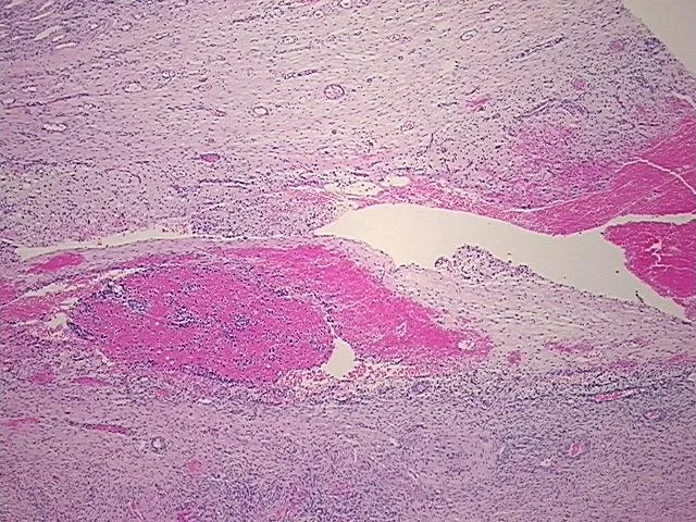 Tissue FFPE Sections, Endometriotic tissue - image 1