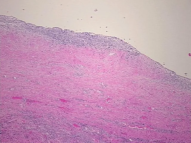 Tissue FFPE Sections, Endometriotic tissue - image 1