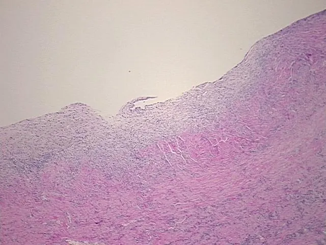 Tissue FFPE Sections, Endometriotic tissue - image 1