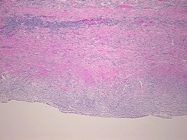 Tissue FFPE Sections, Endometriotic tissue - image 1