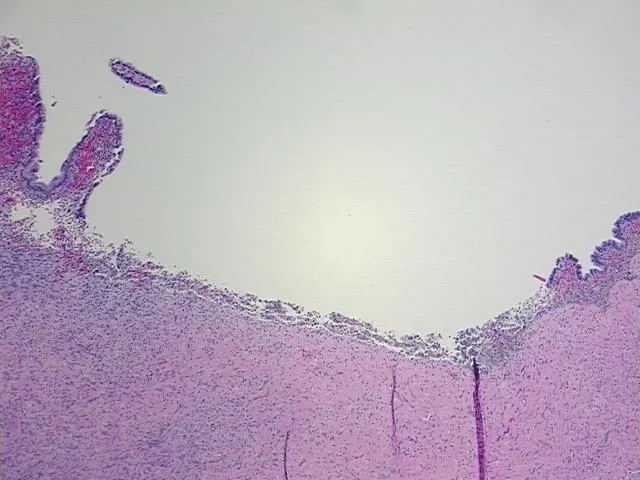 Tissue FFPE Sections, Endometriotic tissue - image 1