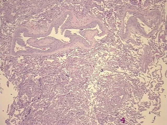Tissue FFPE Sections, Lung: left lower lobe - image 1