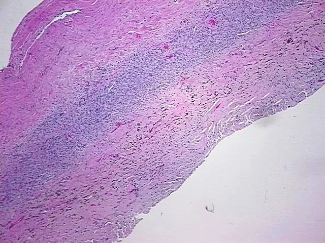Tissue FFPE Sections, Endometriotic tissue - image 1