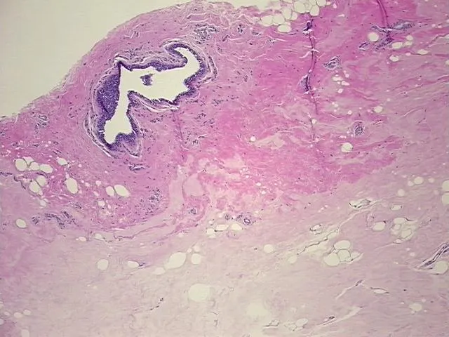 Tissue FFPE Sections, Breast, left - image 1