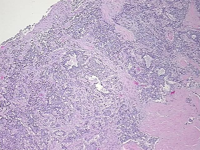 Tissue FFPE Sections, Unknown tissue consistent with neuroendocrine origin - image 1