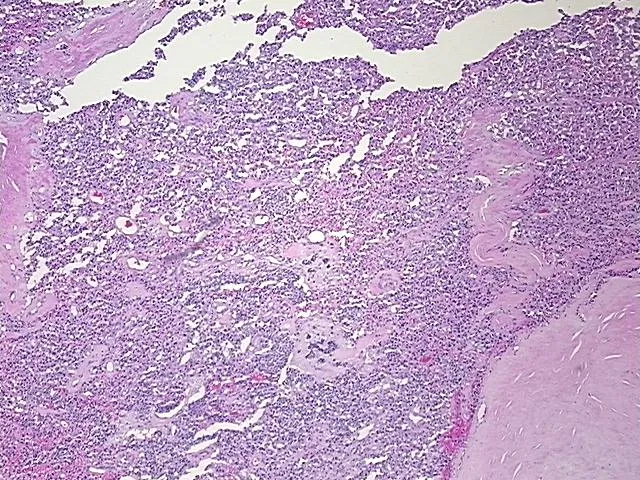 Tissue FFPE Sections, Unknown tissue consistent with neuroendocrine origin - image 1