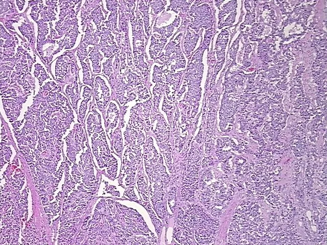 Tissue FFPE Sections, Unknown tissue consistent with neuroendocrine origin - image 1