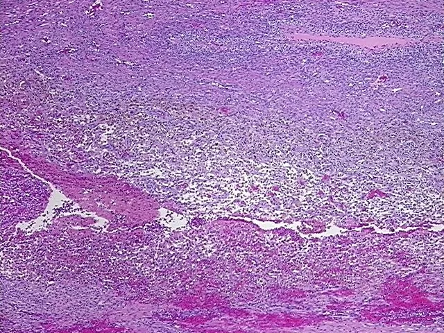 Tissue FFPE Sections, Endometriotic tissue - image 1