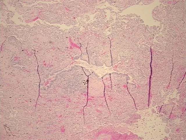 Tissue FFPE Sections, Lung: left upper lobe - image 1