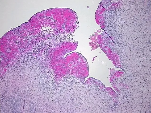 Tissue FFPE Sections, Endometriotic tissue - image 1